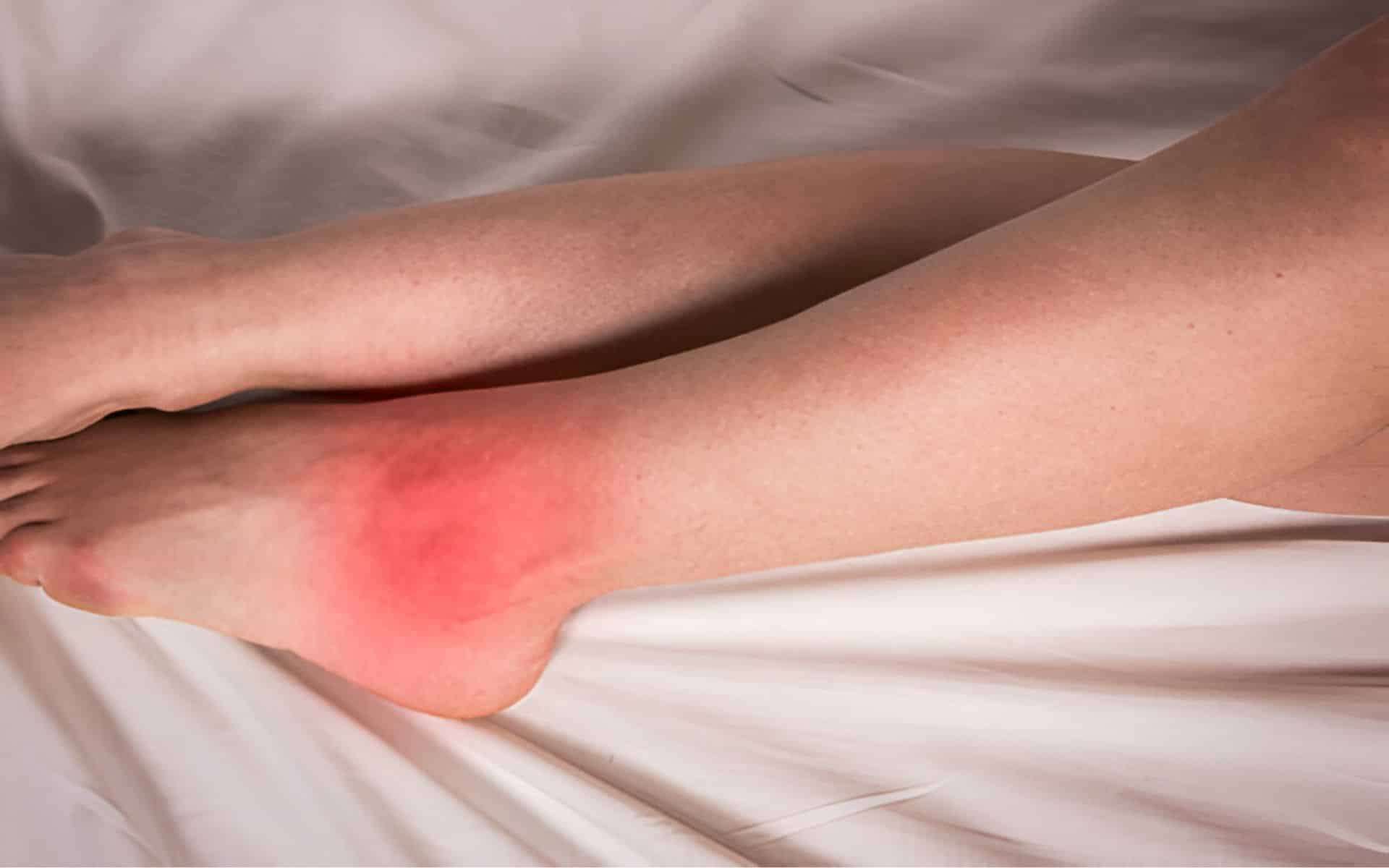 New Study Reveals Genetic Complexity Behind Gout Development 