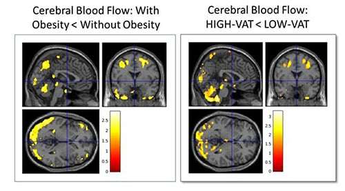 RSNA-PressRelease-2541-figure_4-15ad9b7a878b29e75fe61a0612ac247d.jpg