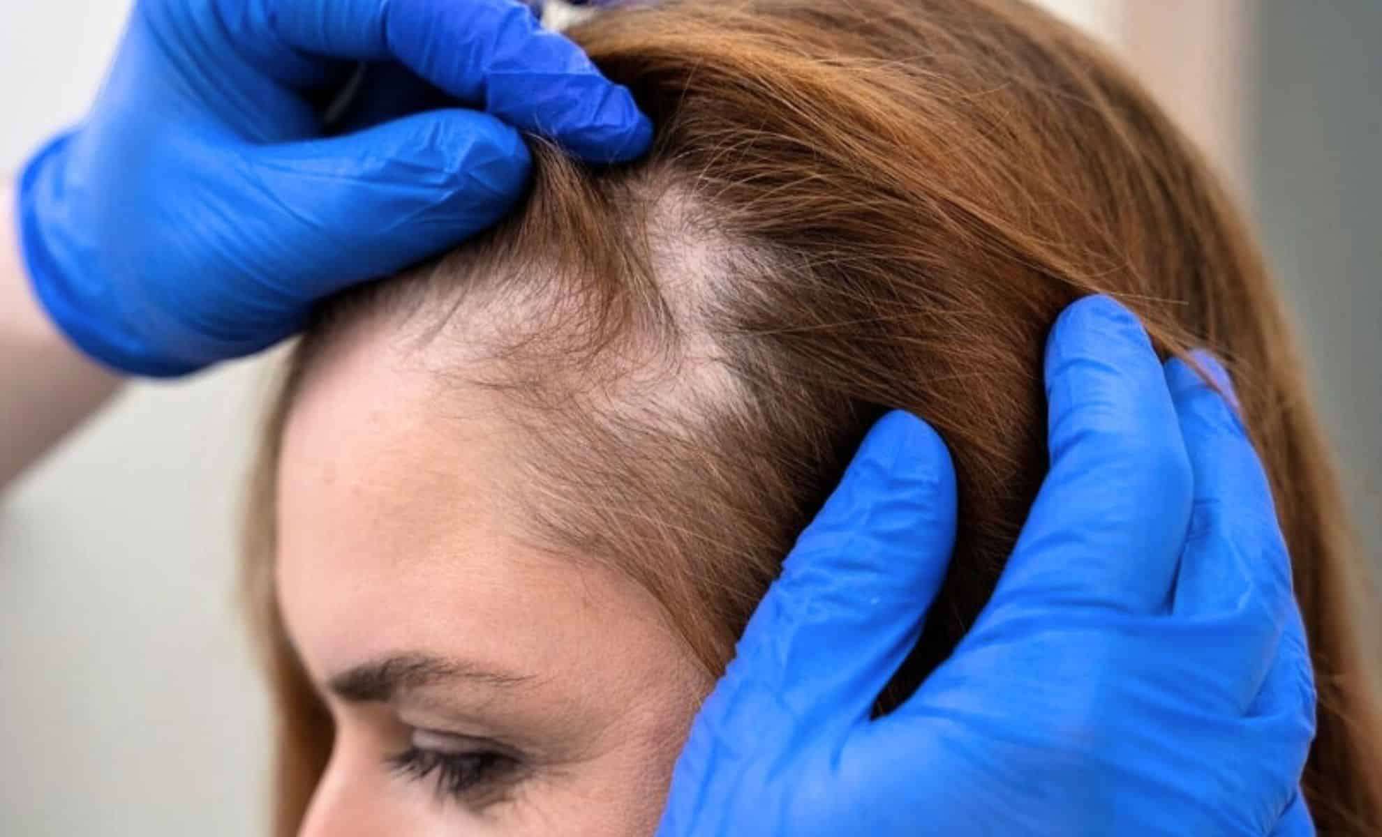 New Sugar-Based Gel Shows Promise for Accelerated Hair Regrowth 