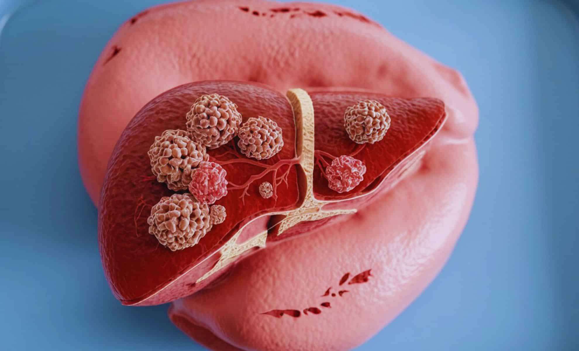 New Research Shows Common Foods Can Cut Liver Fat by Half — What You Should Know 