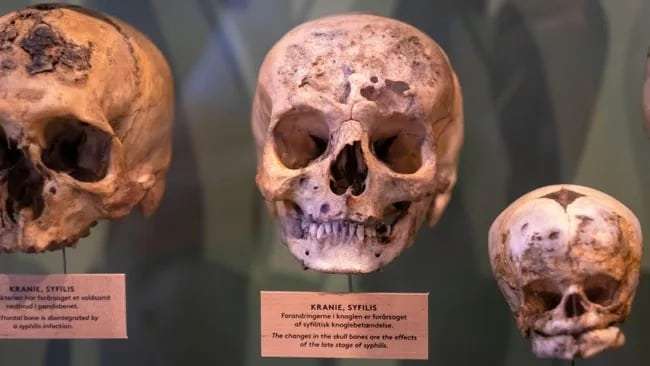 three-skulls-with-signs-of-tertiary-late-stage-syphilis-12e324b8537b6d8cad4a3ca108fe2d79.jpg