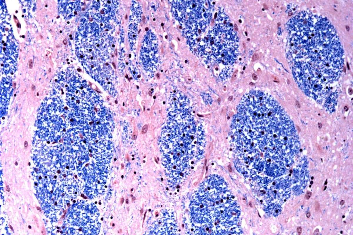 New Insights Into Huntington’s Disease Reveal Genetic Expansion Timeline 