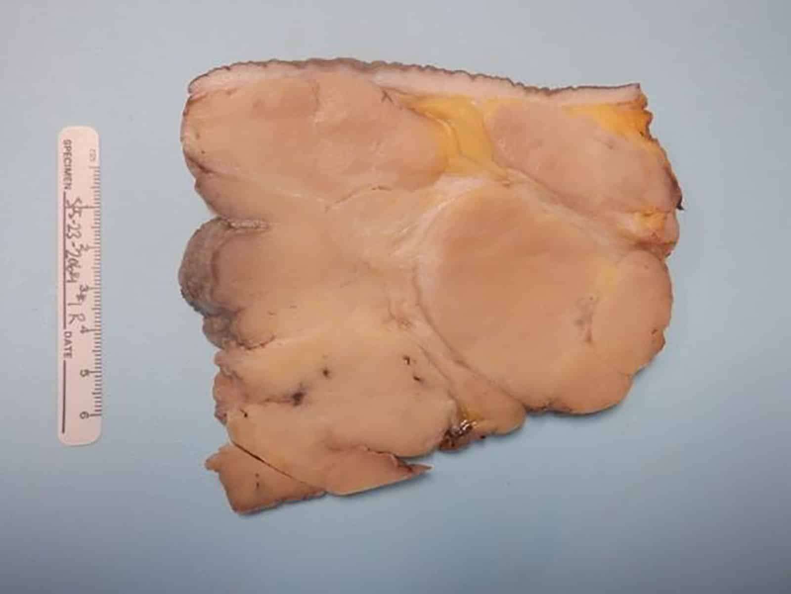Gross-specimen-postbilateral-reduction-mammoplasty-for-gigantomastia-d438944c9604a3af11082e8bb9916ad9.jpeg