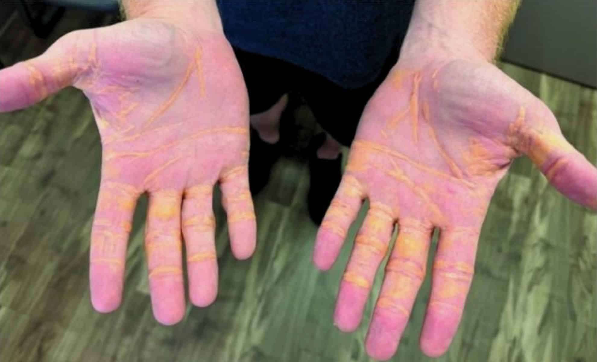 Man Develops Cholesterol Nodules on Hands After Months of Excessive Cheese and Butter Intake 