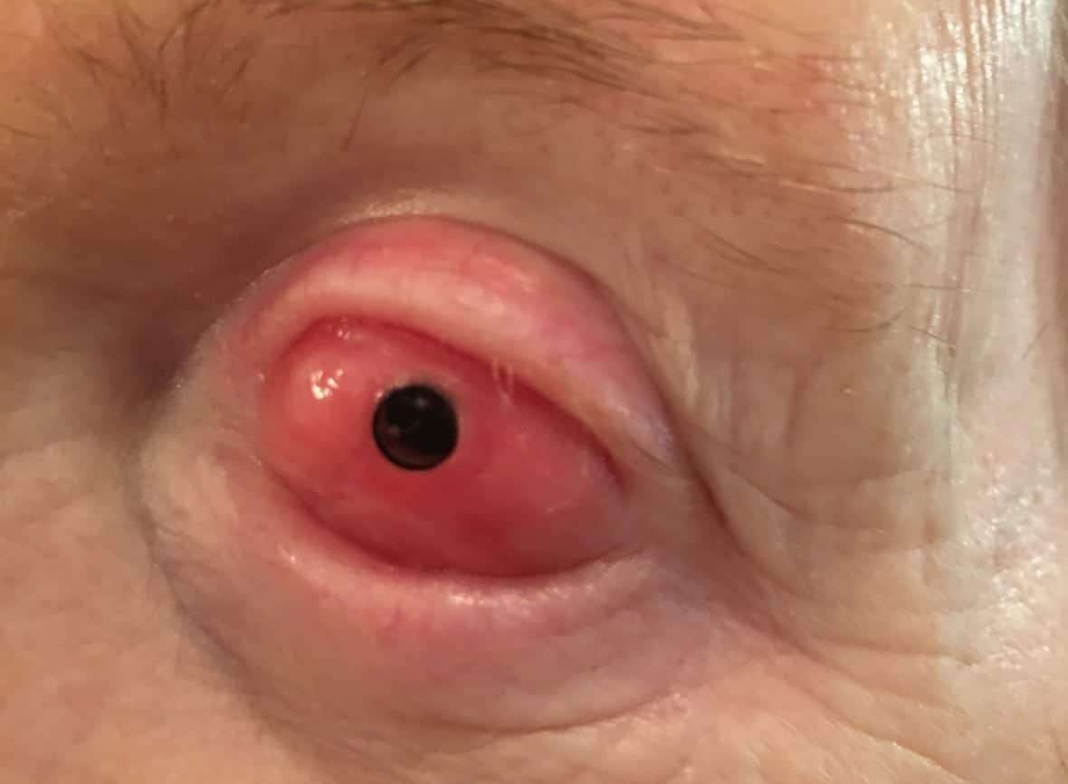 This-is-what-a-patients-eye-looks-like-after-theyve-osteo-odonto-keratoprosthesis-712b8b039a3992f45c86f32adaec73ff.jpeg
