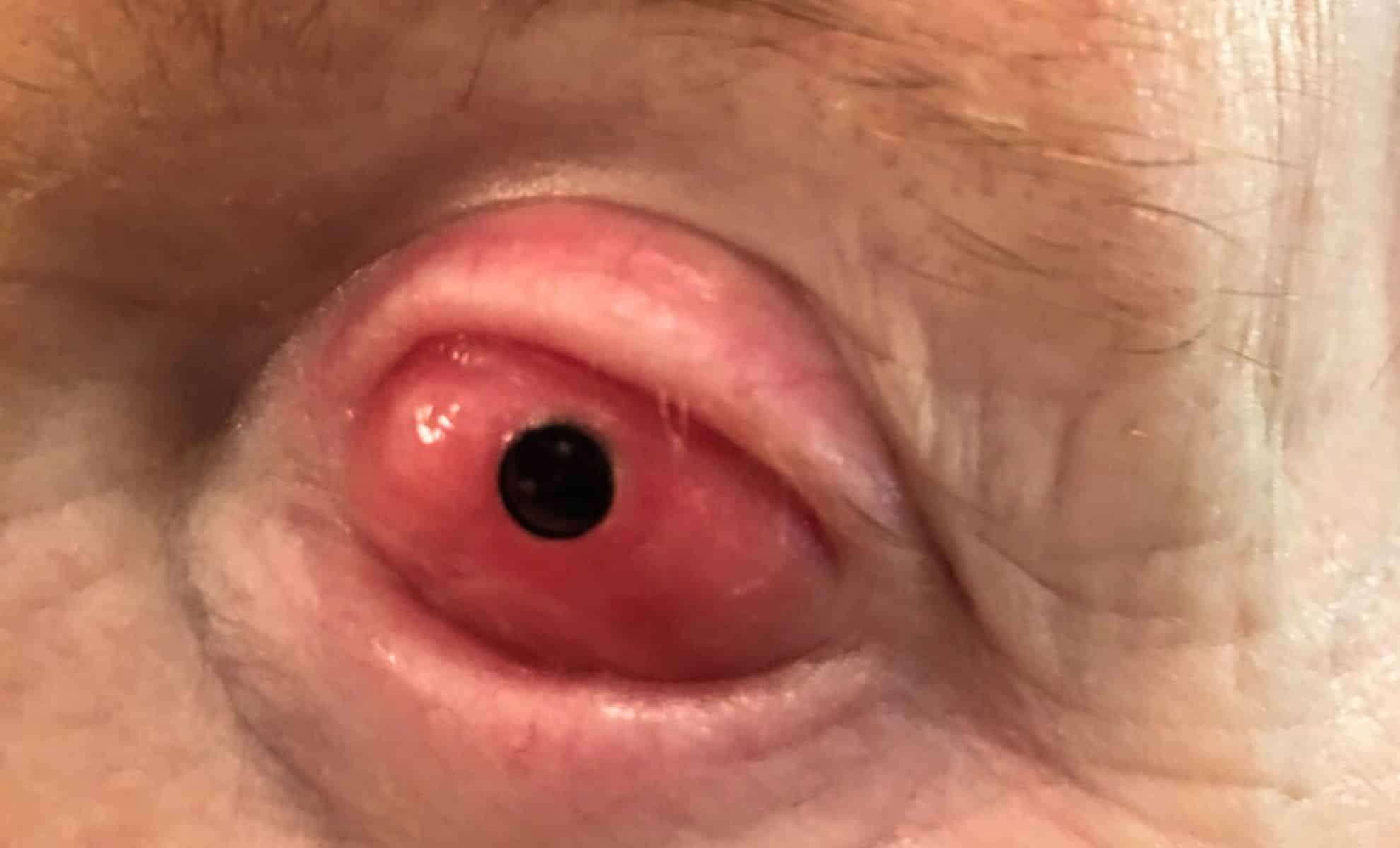 Innovative Surgery Restores Vision by Implanting a Tooth into the Eye 