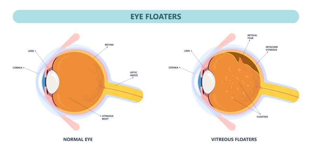 Infographic-of-a-normal-eye-and-myodesopsic-eye-4bc431171bddadc1d76ea7df6bc5af1f.jpeg