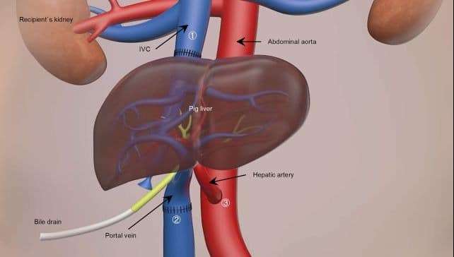 A-schematic-diagram-of-the-surgery-e71d30433ab1f11abedc62ac961fcae2.jpeg