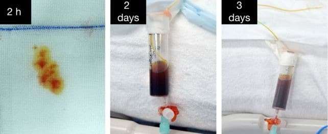 Bile-secreted-by-the-transplanted-liver-ad823f52062a1b87e971520077b4e015.jpeg
