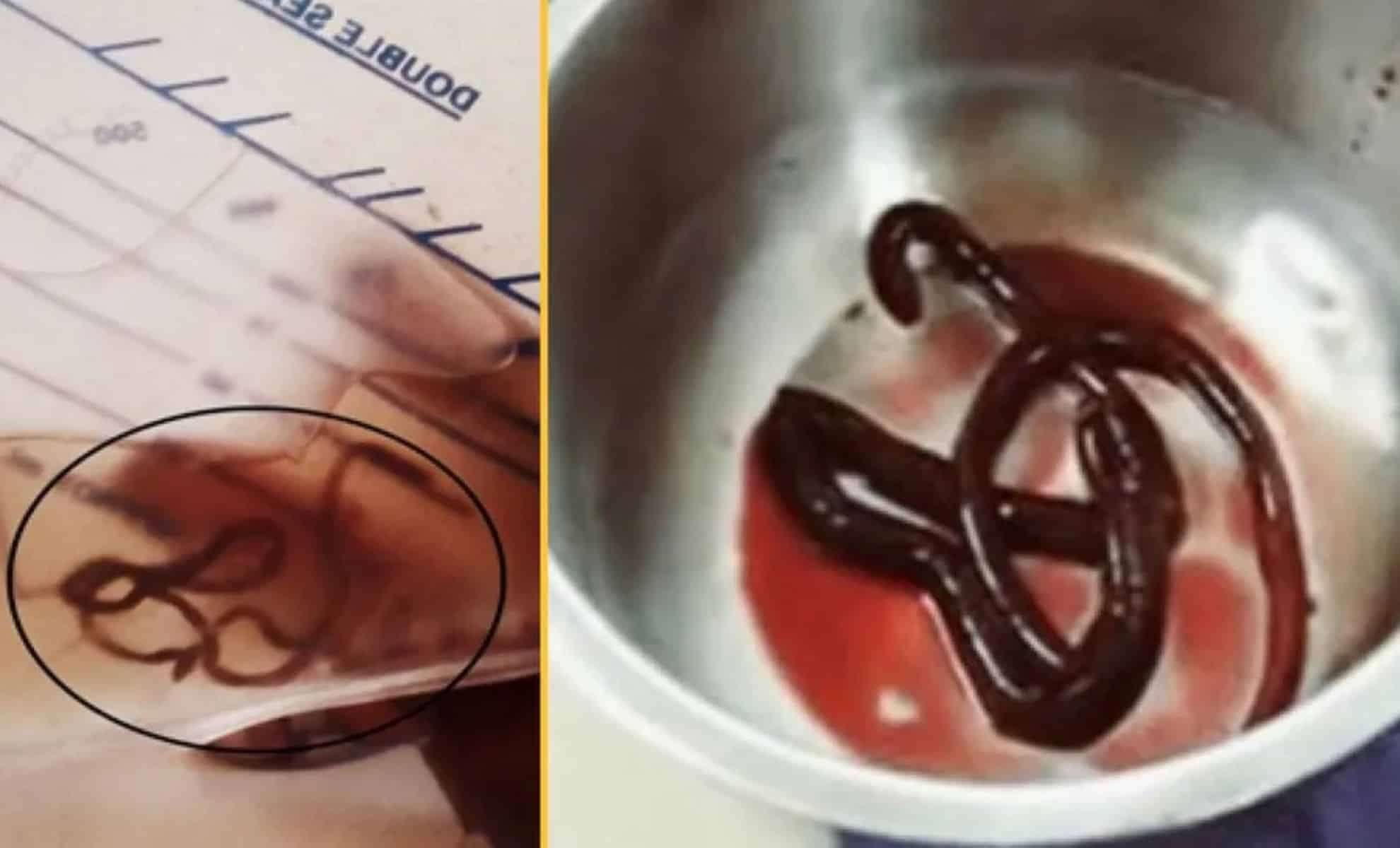 man-couldnt-pee-pulled-out-parasite-9f47be0d02c42da801a096a024bcc898.jpg