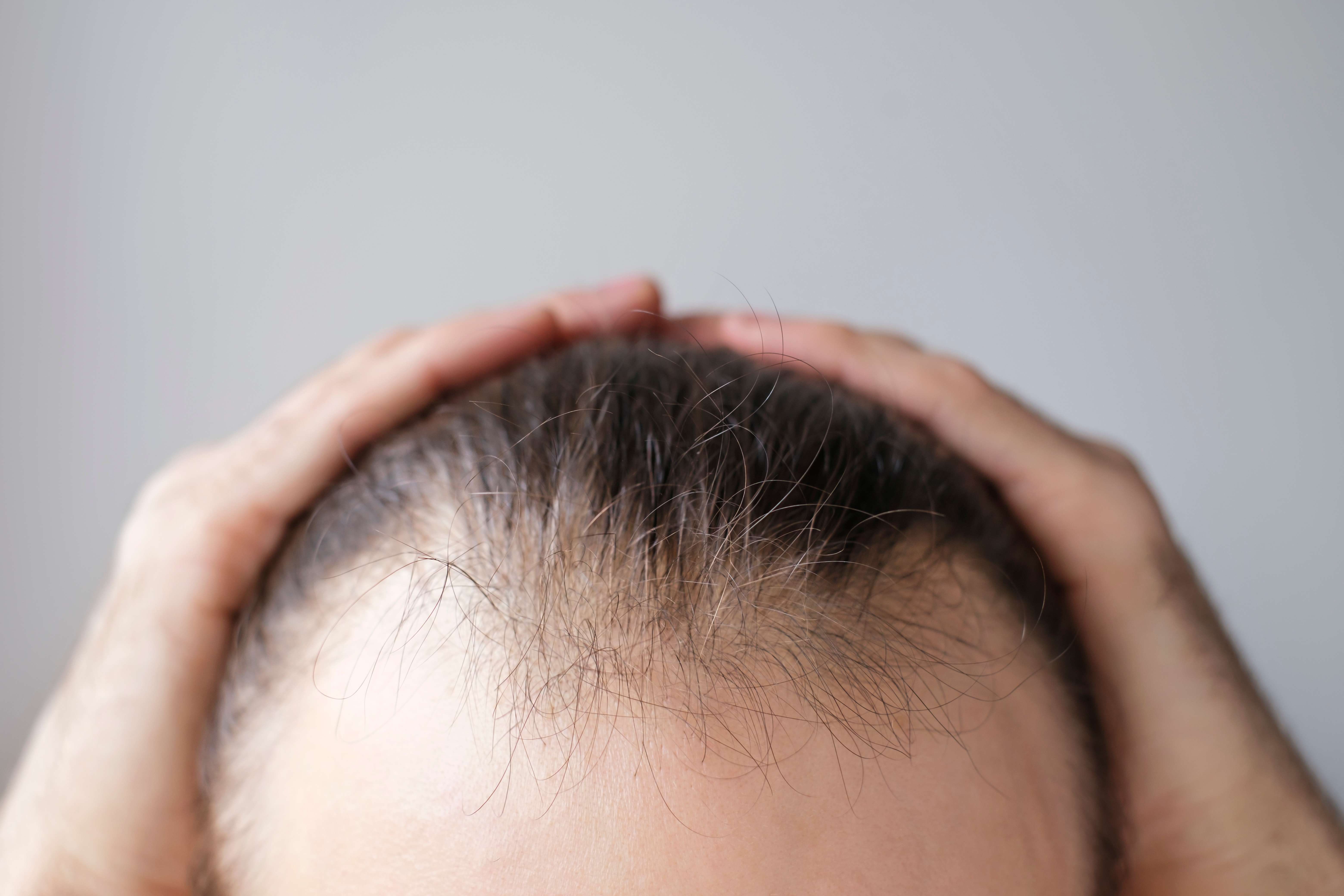 Breakthrough Discovery Reveals How to Potentially Reactivate Hair Growth and Combat Baldness 