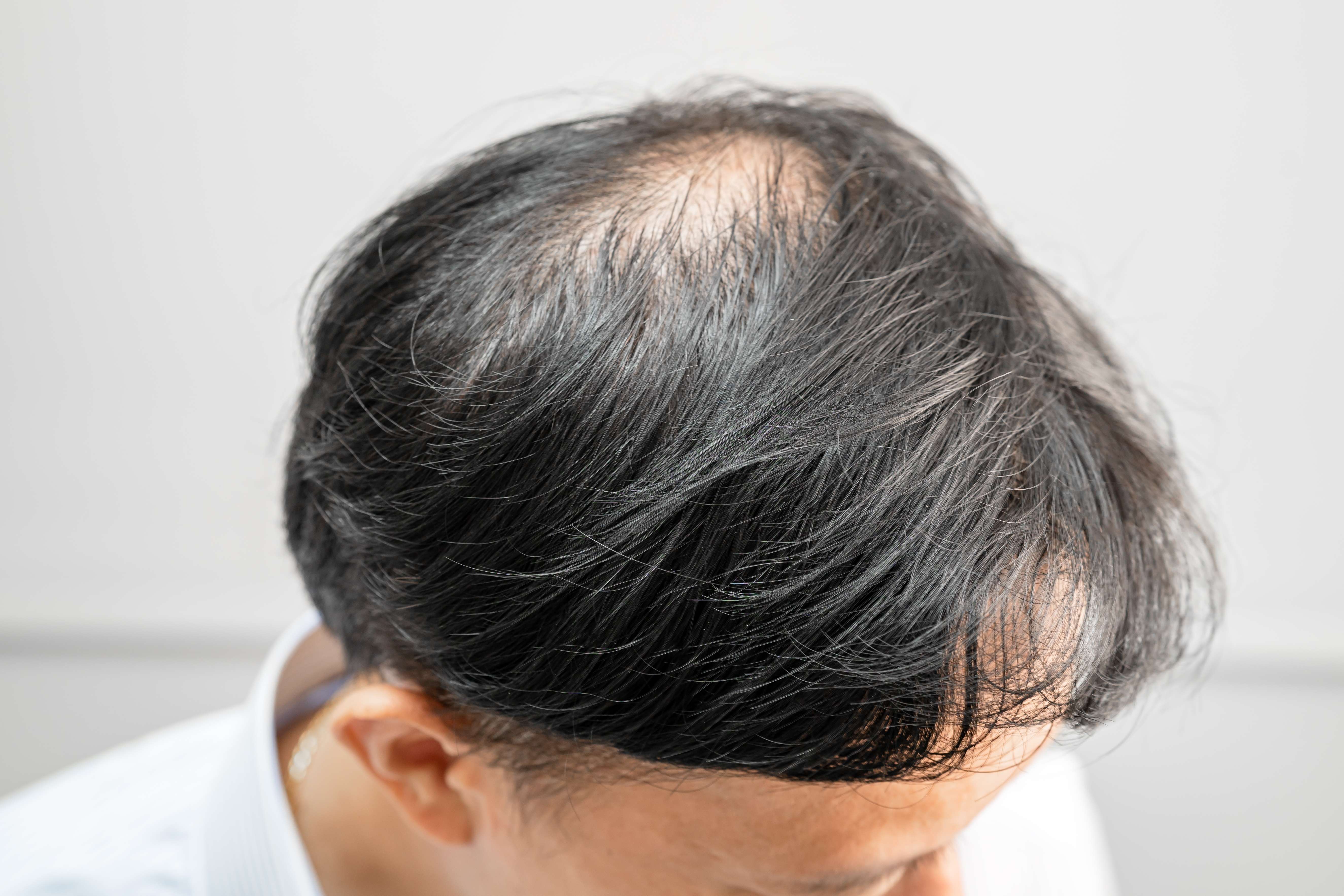 baldness-isnt-permanent-scientists-found-what-stops-hair-from-growing-and-how-to-restart-it-c5b463b052b486dd6f6555982e8bb15b.jpg