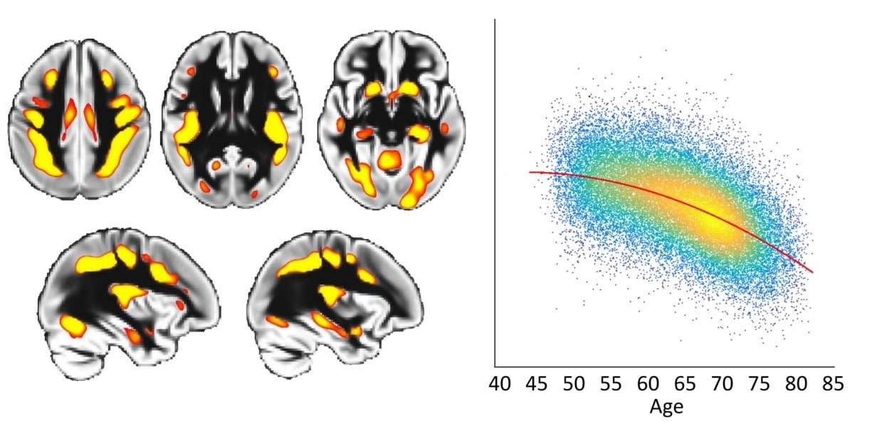 Alzheimers-disease-1-6978f0b32d4c6cddeae1d99fcb78806b.jpeg