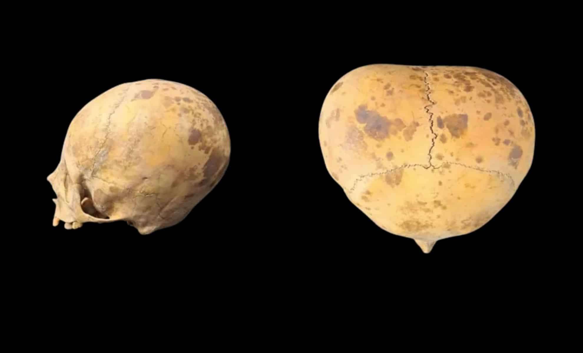 Ancient Cranial Modification in Argentina Reveals Rich Cultural History Behind Unusual Skull Shape 