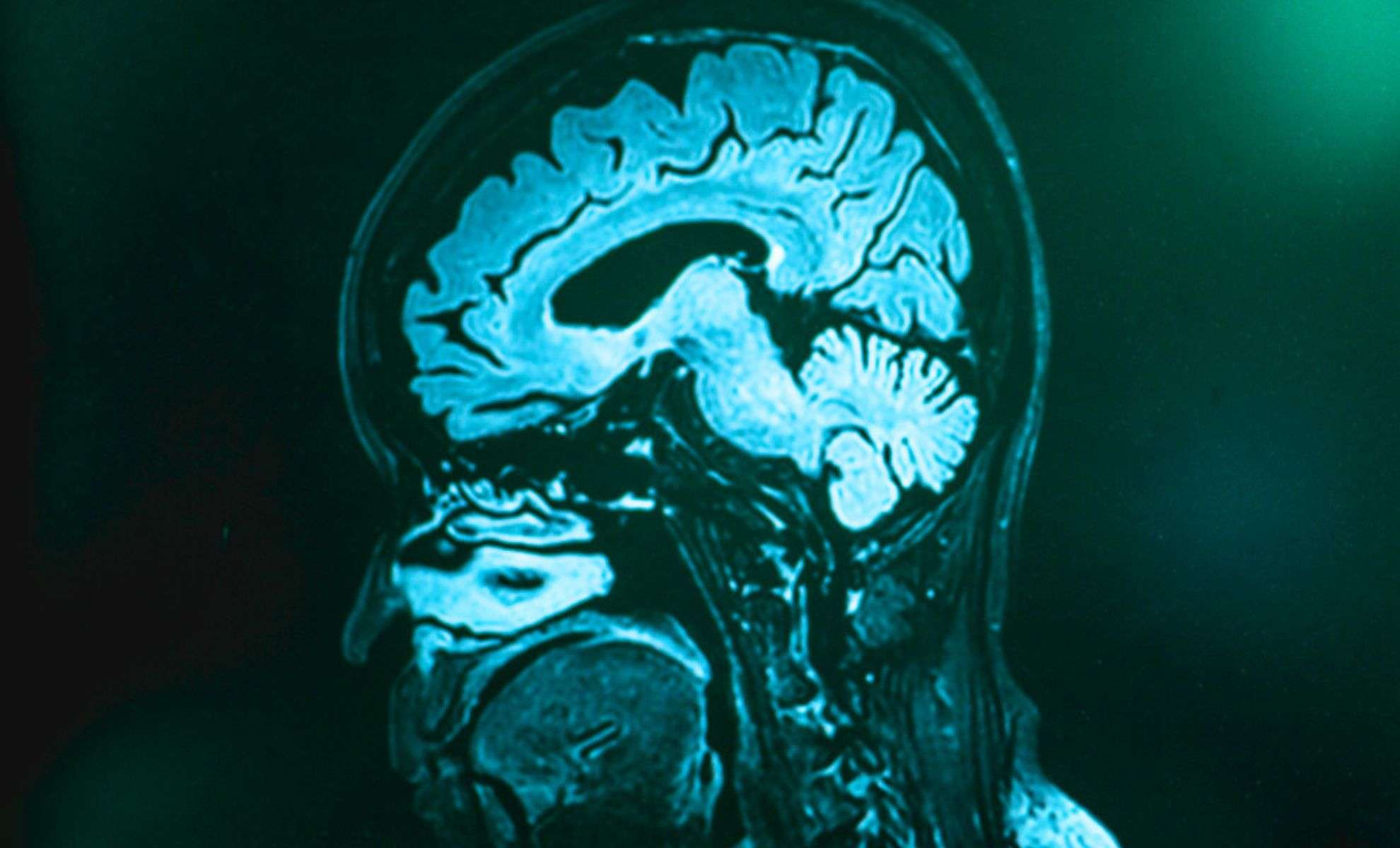 Breakthrough Brain Imaging Unveils Frontotemporal Dementia Years Before Symptoms Appear 