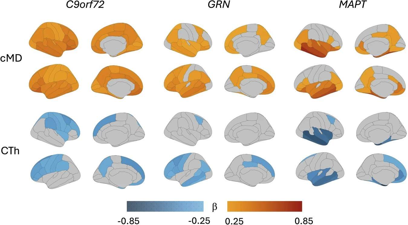 scientists-reveal-new-imaging-technique-that-detects-frontotemporal-dementia-long-before-it-strikes-ce3a1b61807f0f6f1322d860597ac62c.jpeg