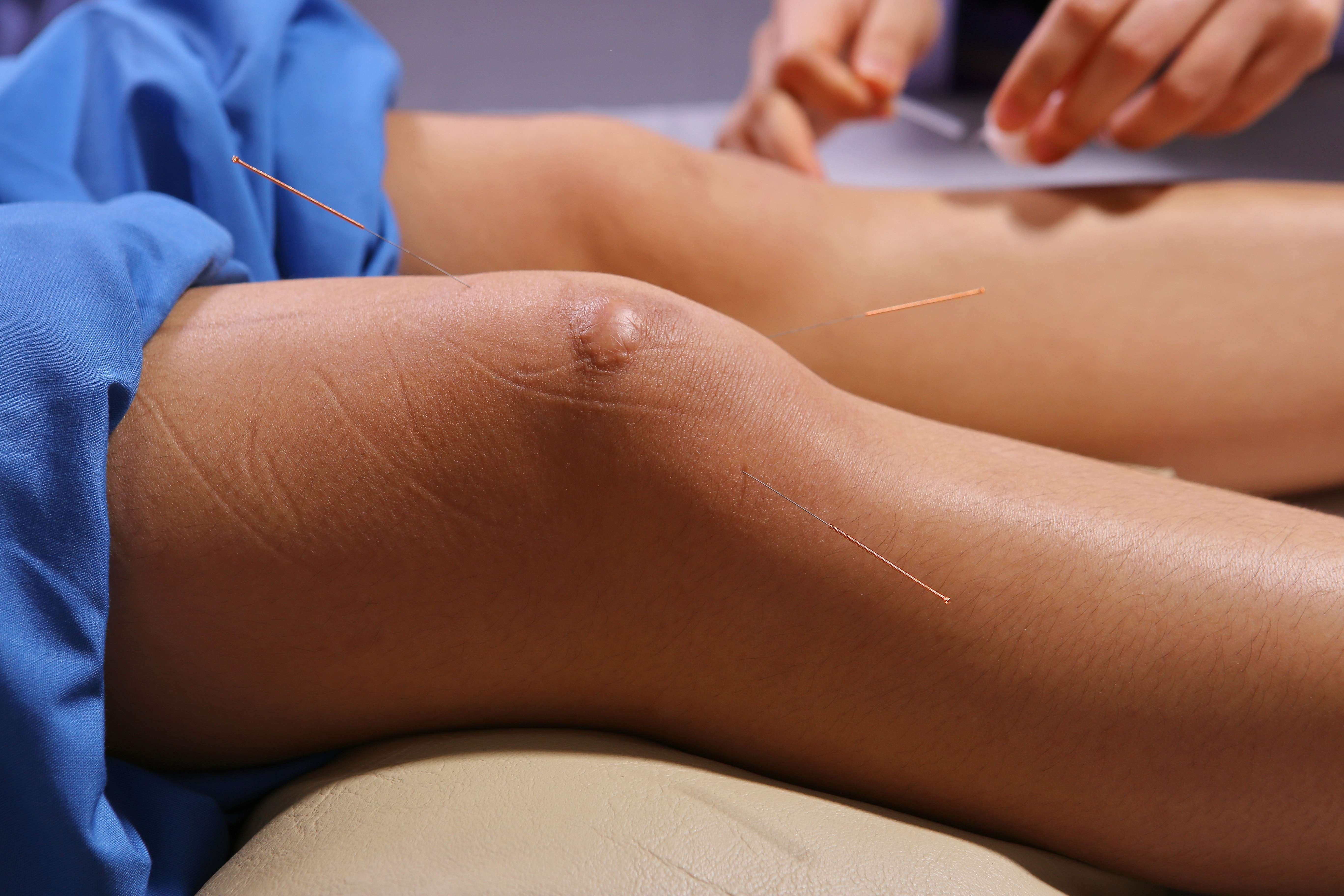 New Study Reveals Low-Dose Radiation as a Promising Alternative for Knee Osteoarthritis Relief 