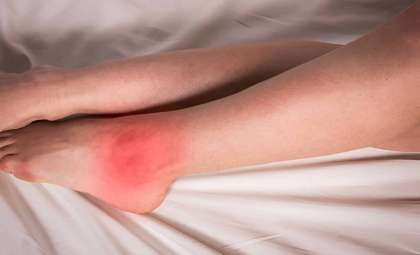 New Study Reveals Genetic Complexity Behind Gout Development