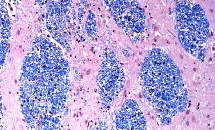New Insights Into Huntington’s Disease Reveal Genetic Expansion Timeline