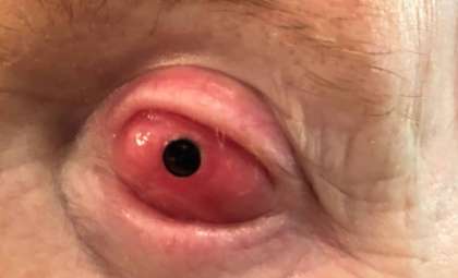 Innovative Surgery Restores Vision by Implanting a Tooth into the Eye
