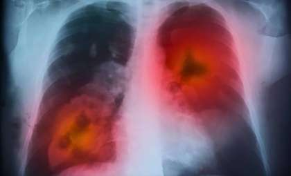 New Research Links Diet and Glycogen to Lung Cancer Progression