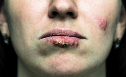 Scientists Unveil How Cold Sore Virus Reshapes Human DNA—and Reveal Its Achille's Heel