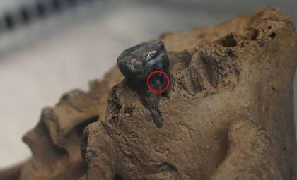 Unveiling the 'Dragon Man' Skull: Key to Understanding Denisovan Humans