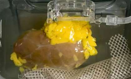 Scientists Achieve First Successful Transplant of Blood Type-Modified Kidney in Brain-Dead Human