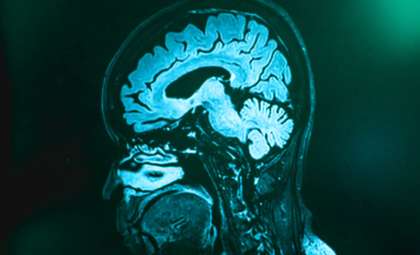 Breakthrough Brain Imaging Unveils Frontotemporal Dementia Years Before Symptoms Appear