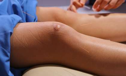 New Study Reveals Low-Dose Radiation as a Promising Alternative for Knee Osteoarthritis Relief