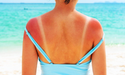 Breakthrough Study Identifies RNA Damage as the Key Trigger of Sunburn Inflammation